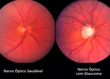 Glaucoma, posso ficar cego?