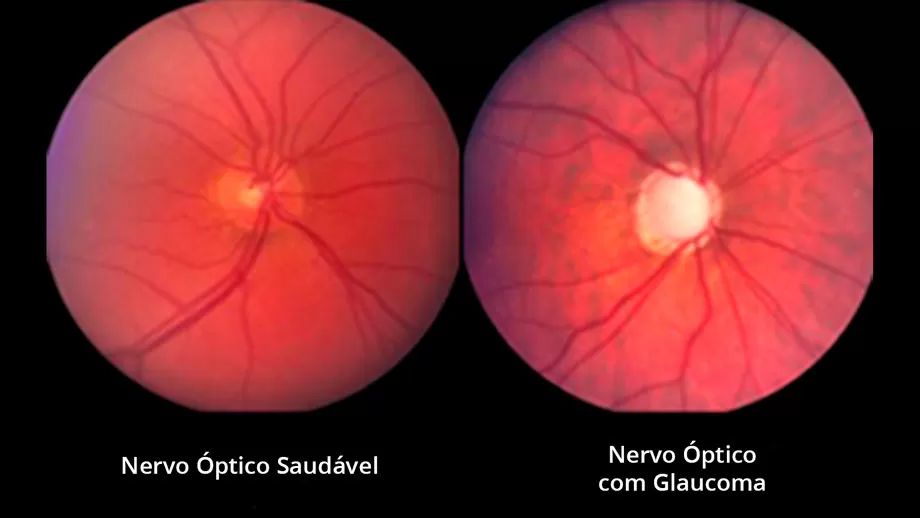 Glaucoma, posso ficar cego?