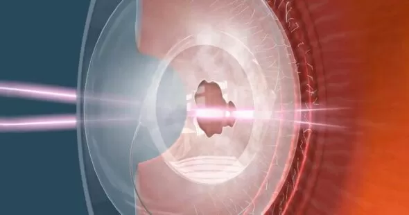 Capsulotomia Posterior com YAG Laser