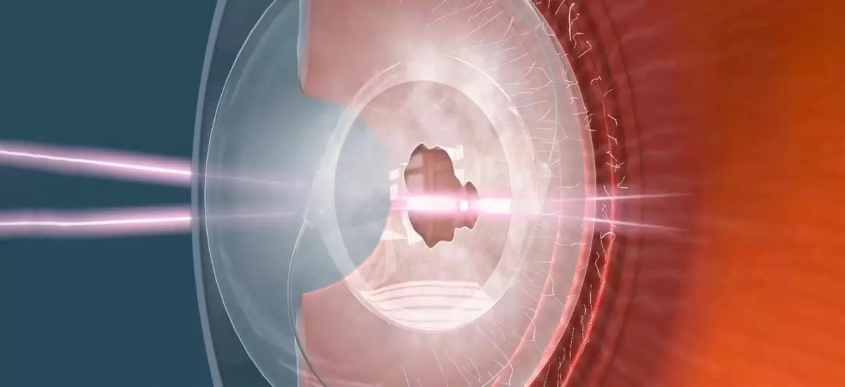 Capsulotomia Posterior com YAG Laser