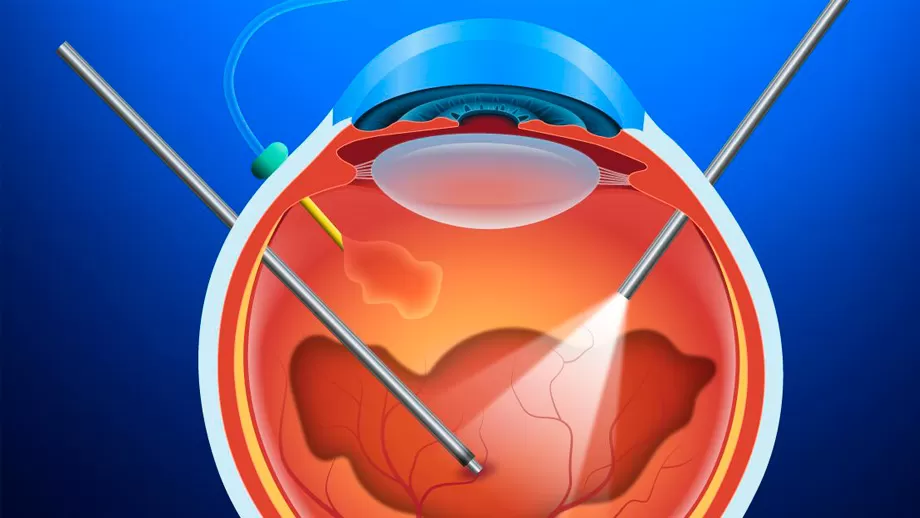 Vitrectomia e Suas Indicações de Forma Prática