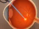 Laser de Retina